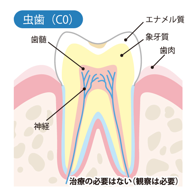 虫歯（C1）